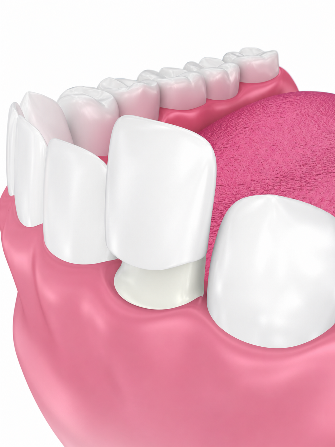 Lentes de Contato Dental e Facetas